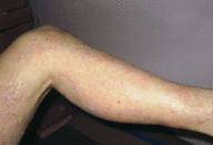 Mike Suffered from Psoriasis Sufferer for 29 Years; Finally Finds Relief